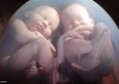 双胞胎症状（孕妇怀有双胞胎4个症状很明显）
